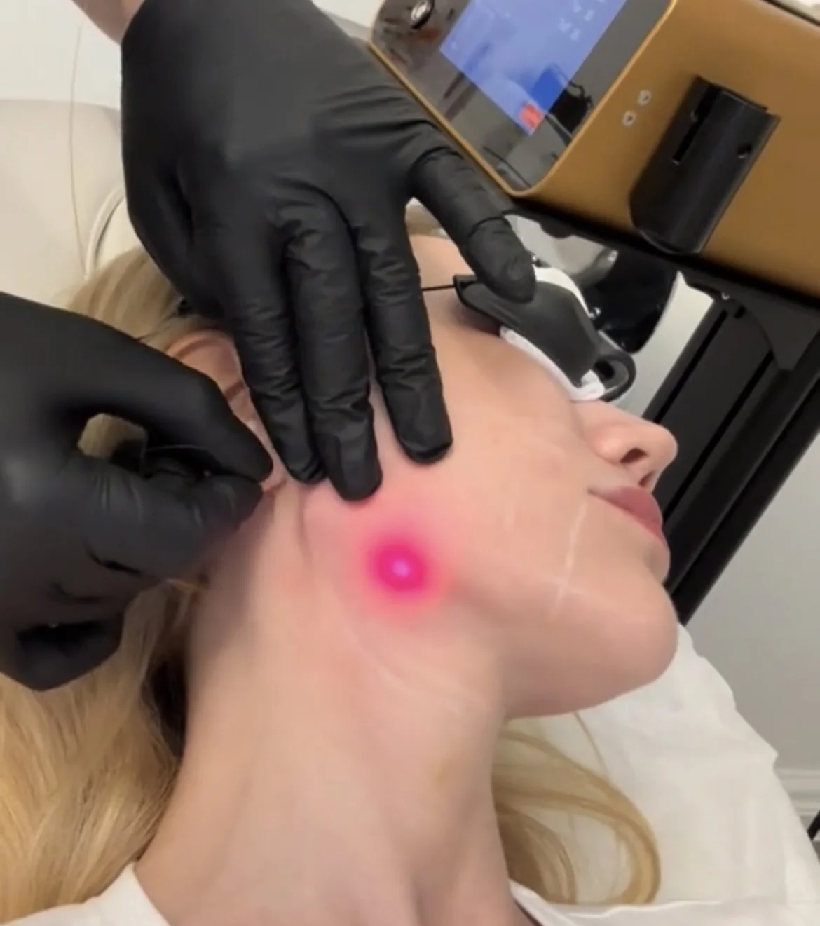 Endo Laser Treatment