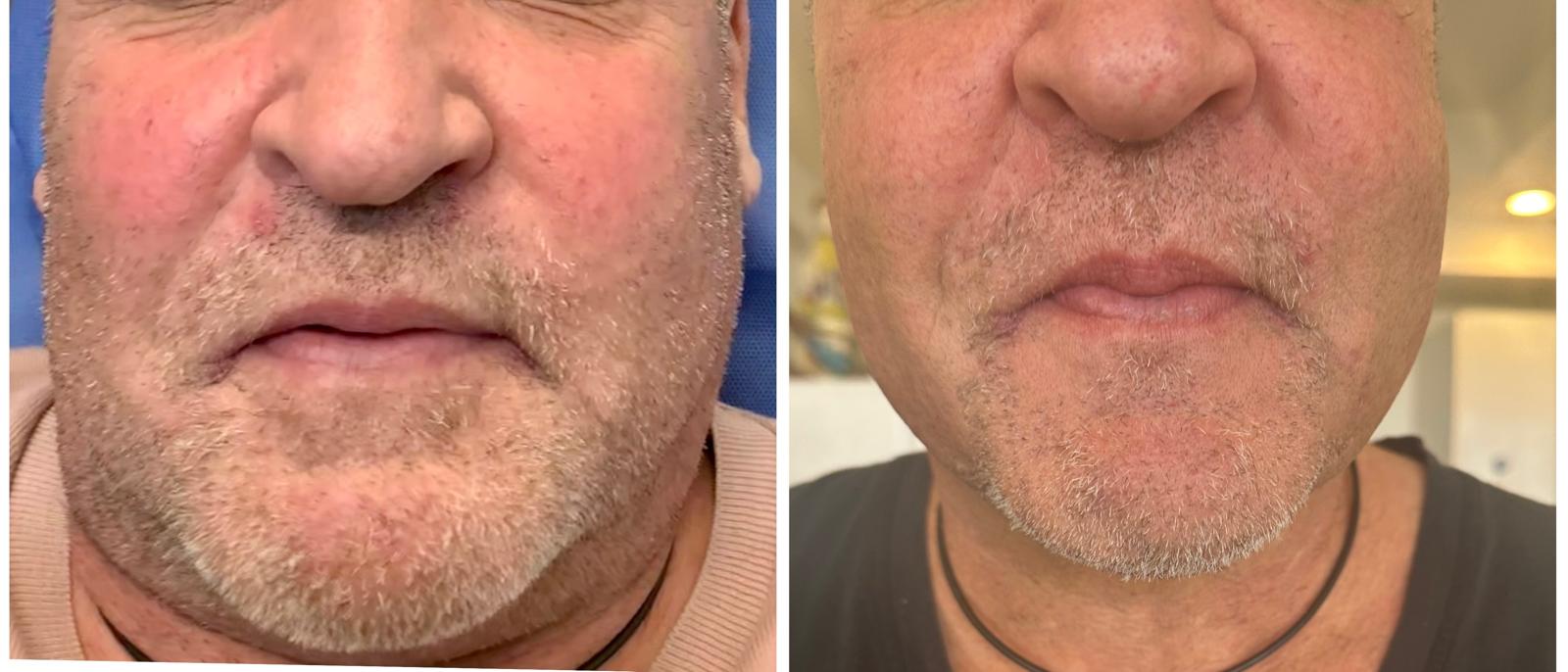 Endo Lift Before and After