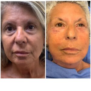 EndoLift Before and After
